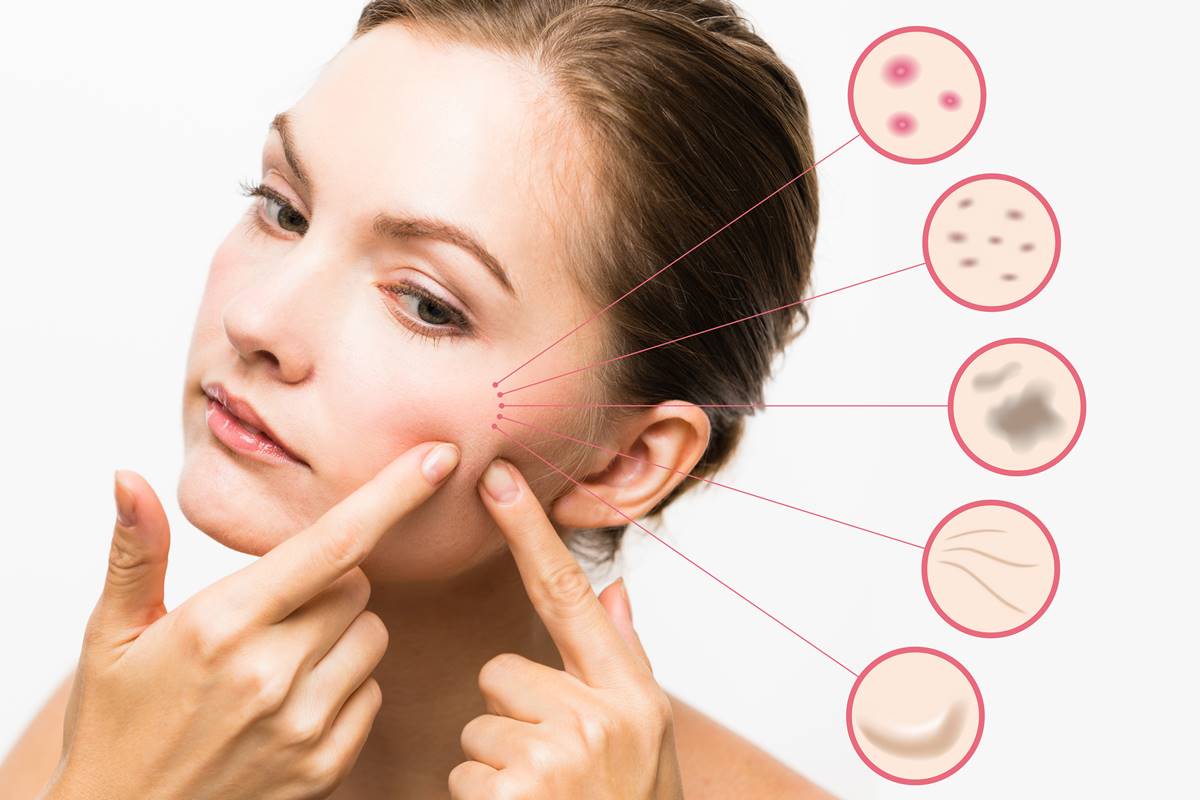 A Novel Research That May Permanently Treat Acne - TheHealthMania