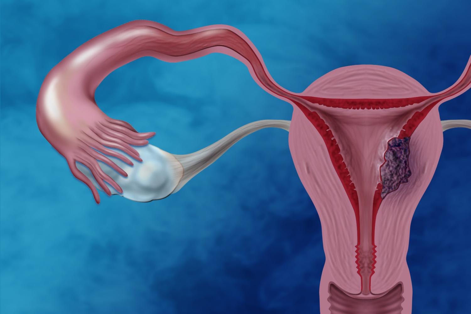 First Ever Comprehensive Study On The Endometrial Cancer TheHealthMania