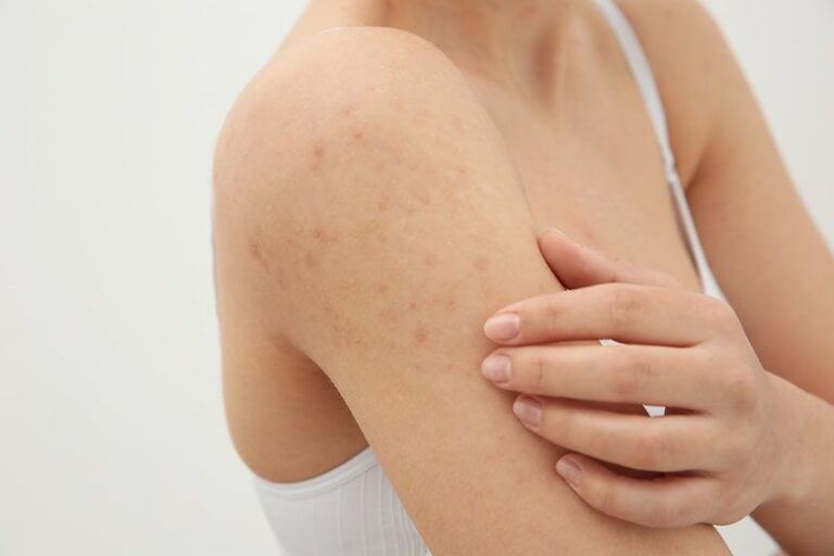 how-to-prevent-bumps-and-acne-after-waxing-thehealthmania